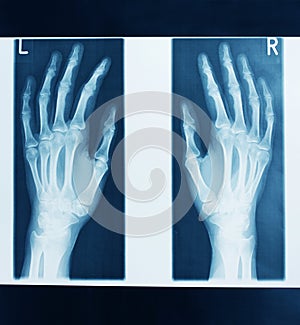 X-ray picture hands