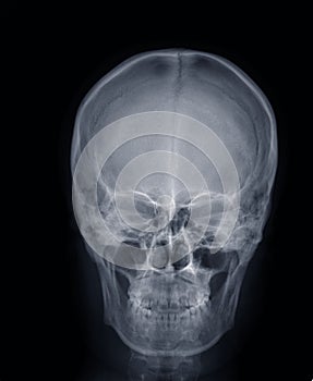 X-ray picture:human head