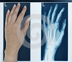 X-ray picture left hand
