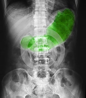 X- ray of plan abdomen supine position. photo