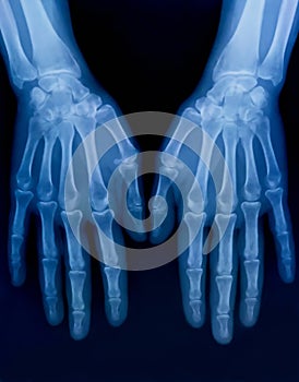 X-ray plate of the bones of the both human hands
