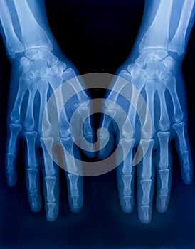 X-ray plate of the bones of the both human hands