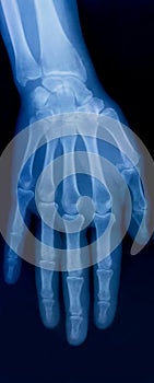 X-ray plate of the bones of the human hand