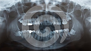 X-Ray of problematic wisdom teeth