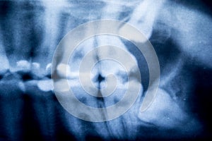 X-Ray of problematic wisdom teeth