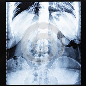 X-ray radiogram of human body before Barium study photo