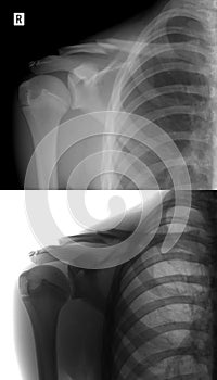 X-ray of the right collarbone. Fracture of clavicle of the child. Positive. Negative.