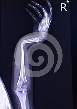 X-ray right forearm A girl 5 year old showing fracture distal 1/3 right radius and ulnar,Angular of the distal part of fracture,So photo