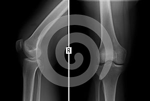 X-ray of the right knee joint. Fracture of the lateral condyle of the tibial. photo