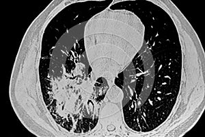 X ray of right lung infection.