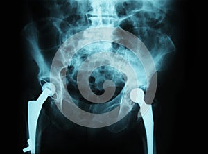 x-ray/ rtg of human pelvis - hip joint replacemen