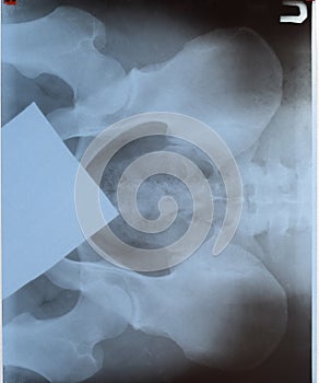 X-ray of the  and sacrum. X-ray