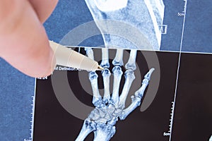 X-ray scan of hand, bones and finger joints. Doctor pointed on finger small joints, where pathology is detected, such as arthritis photo