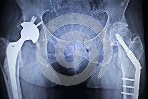 X-ray scan image of hip joint replacement orthopedic implant