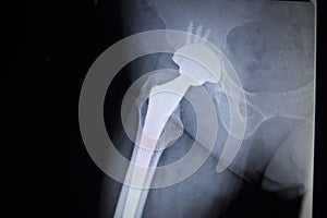 X-ray scan image of hip joint replacement orthopedic implant