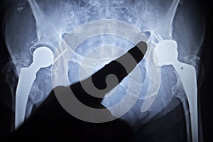 X-ray scan image of hip joint replacement orthopedic implant