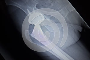 X-ray scan image of hip joint replacement orthopedic implant