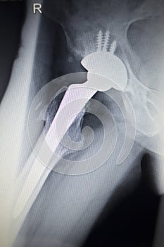 X-ray scan image of hip joint replacement orthopedic implant