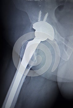 X-ray scan image of hip joint replacement orthopedic implant