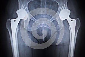 X-ray scan image of hip joint replacement orthopedic implant