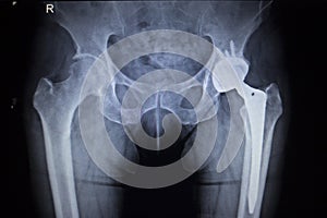 Skenovať obraz z bedro kĺb výmena ortopedický implantát 