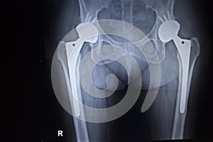 X-ray scan image of hip joint replacement orthopedic implant