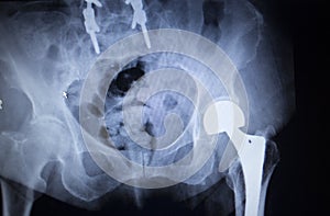 X-ray scan image of hip joint replacement orthopedic implant