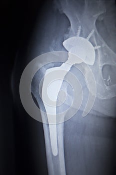 X-ray scan image of hip joint replacement orthopedic implant