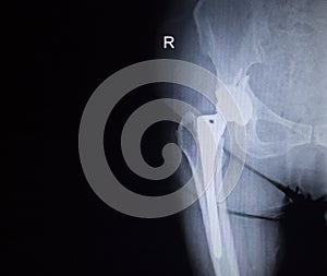 X-ray scan image of hip joint replacement orthopedic implant