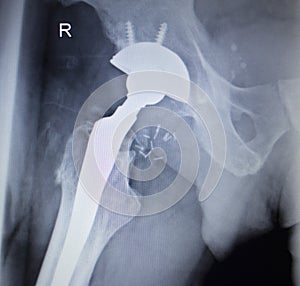 X-ray scan image of hip joint replacement orthopedic implant