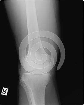X-ray scan of a right knee