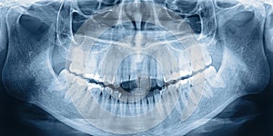 X-ray scan of teeth