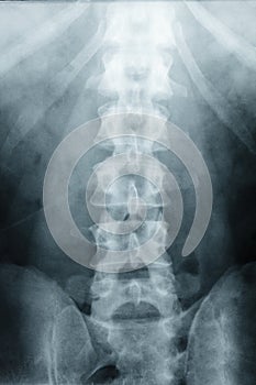 X-ray Scoliosis film x-ray lumbar spine AP