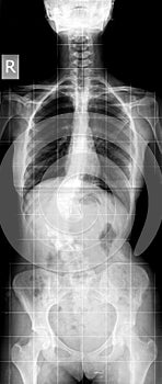X-ray of scoliosis photo