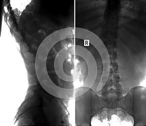 X-ray scoliosis of the lumbar spine. Negative. photo