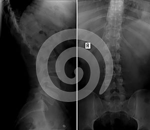 X-ray scoliosis of the lumbar spine. photo