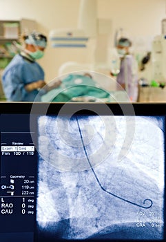 X-ray screen coronarography surgery