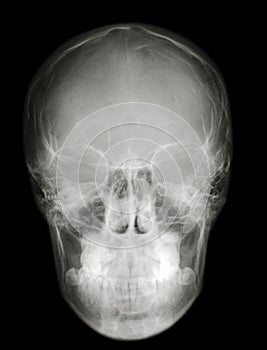 X-ray scull front profile