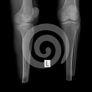 X-ray of the shin. Stump of the left shin.