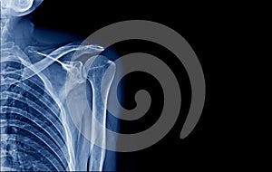 X-ray shoulder in blue tone