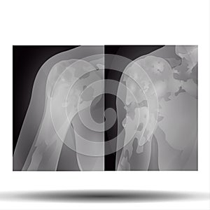 X-ray of Shoulder Bone - Human Body - Science - Healthcare