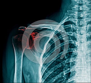 X-ray shoulder fracture in blue tone