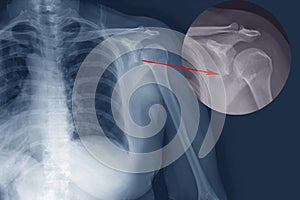 X-ray shoulder Fracture posterior half of glenoid with posterior dislocation of the bone fragment.