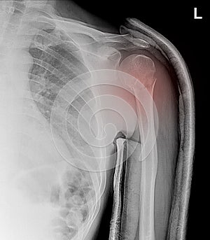 X-ray shoulder showed closed fracture left humerus photo