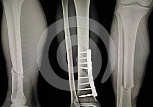 X-ray show fracture leg tibia and fibular