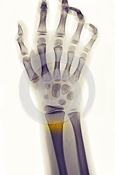 X-ray showing fracture of the distal radius