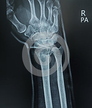 x-ray showing intra-articular comminuted fracture distal radius. Medical image concept.