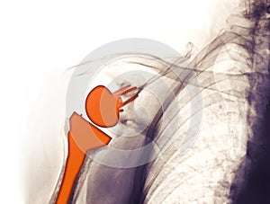 X-ray showing a shoulder replacement