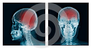 X-ray skull