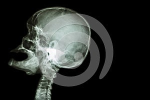 X-ray skull open mouth ( side view ) and Stroke ( Cerebrovascular accident ( CVA ) ) and blank area at right side